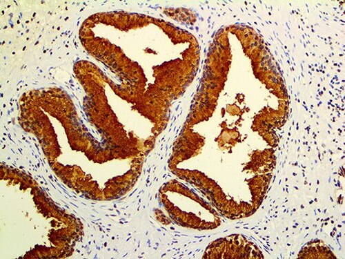 IHC of PSAP Mmab on an FFPE Prostate Tissue